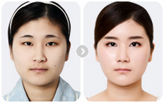 台湾原版双眼皮真人案例