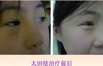 太田痣是怎样形成的