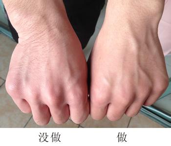 手部除皱对比图