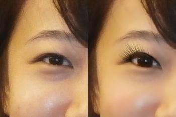 提眉术恢复期是多久？