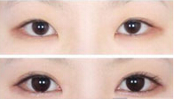 开眼角会留下明显疤痕吗？