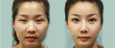 双眼皮手术影响视力吗