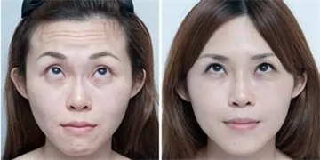 玻尿酸一针多少钱